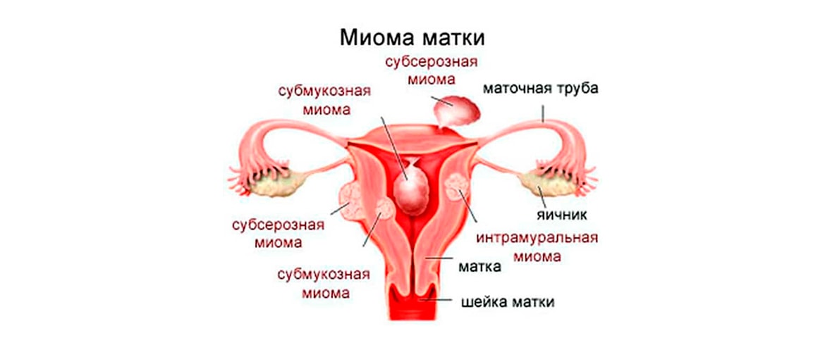 Миома матки размеры